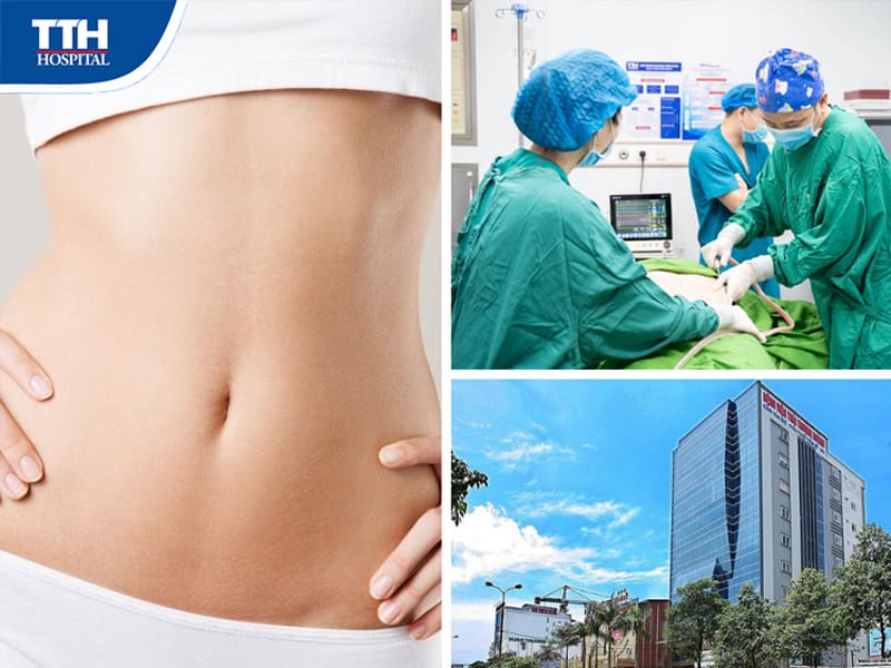 Địa chỉ tạo hình thành bụng tốt nhất tại Vinh, Nghệ An