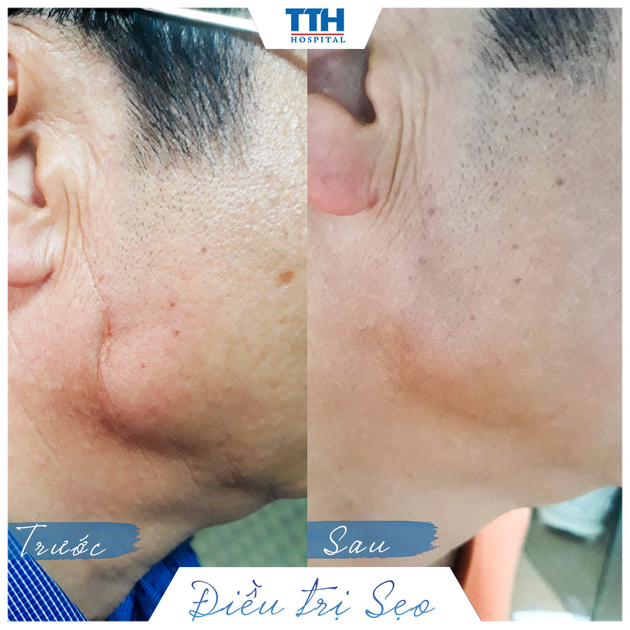 Hình ảnh khách hàng sau khi thực hiện điều trị sẹo tại Bệnh viện Thái Thượng Hoàng