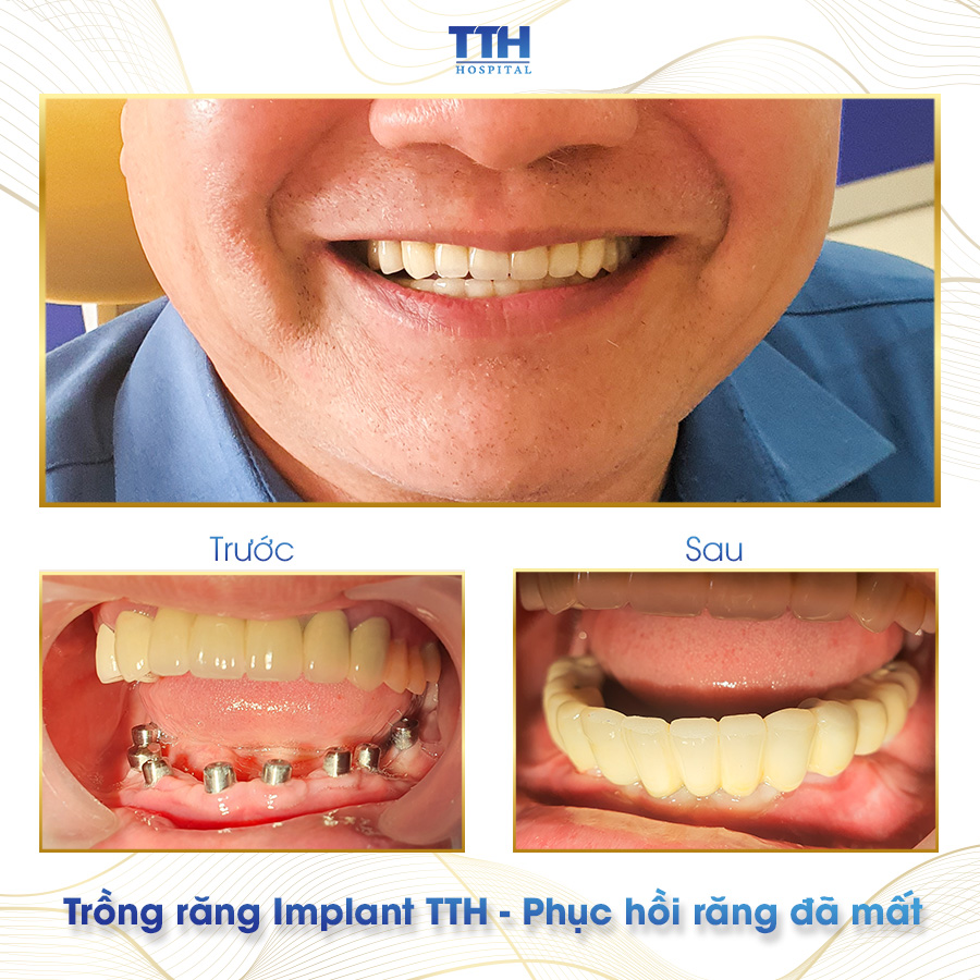 Kết quả khách hàng sau trồng răng Implant tại Bệnh viện Thái Thượng Hoàng