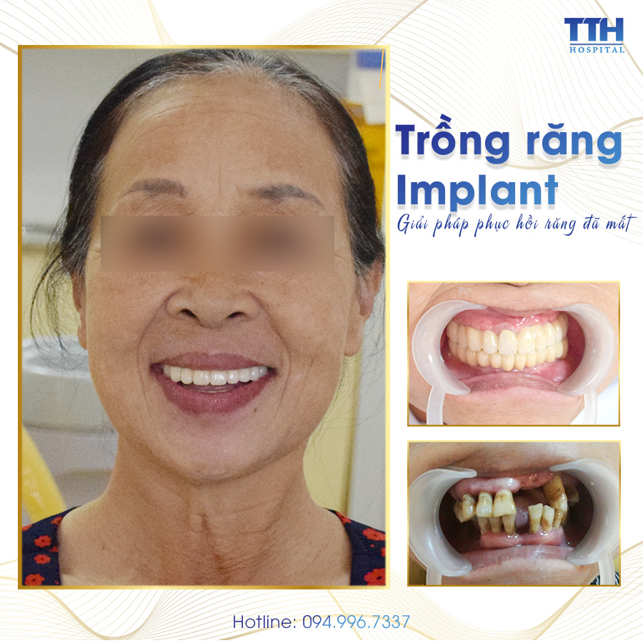 Bệnh viện Thái Thượng Hoàng - Địa chỉ trồng răng Implant uy tín tại Nghệ An, Hà Tĩnh