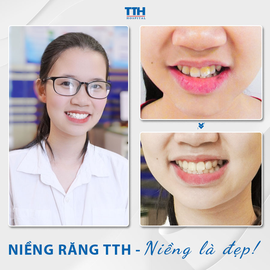 Loạt hình ảnh khách hàng sau khi niềng răng tại Bệnh viện Thái Thượng Hoàng 4