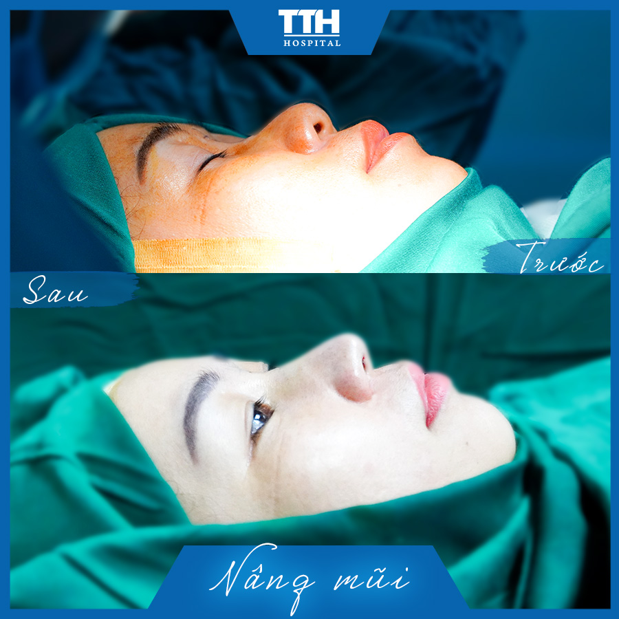 Kết quả nâng mũi nội soi của khách hàng tại Bệnh viện Thái Thượng Hoàng
