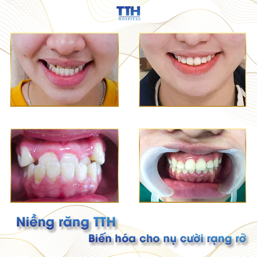Kết quả niềng răng mắc cài tại Thái Thượng Hoàng