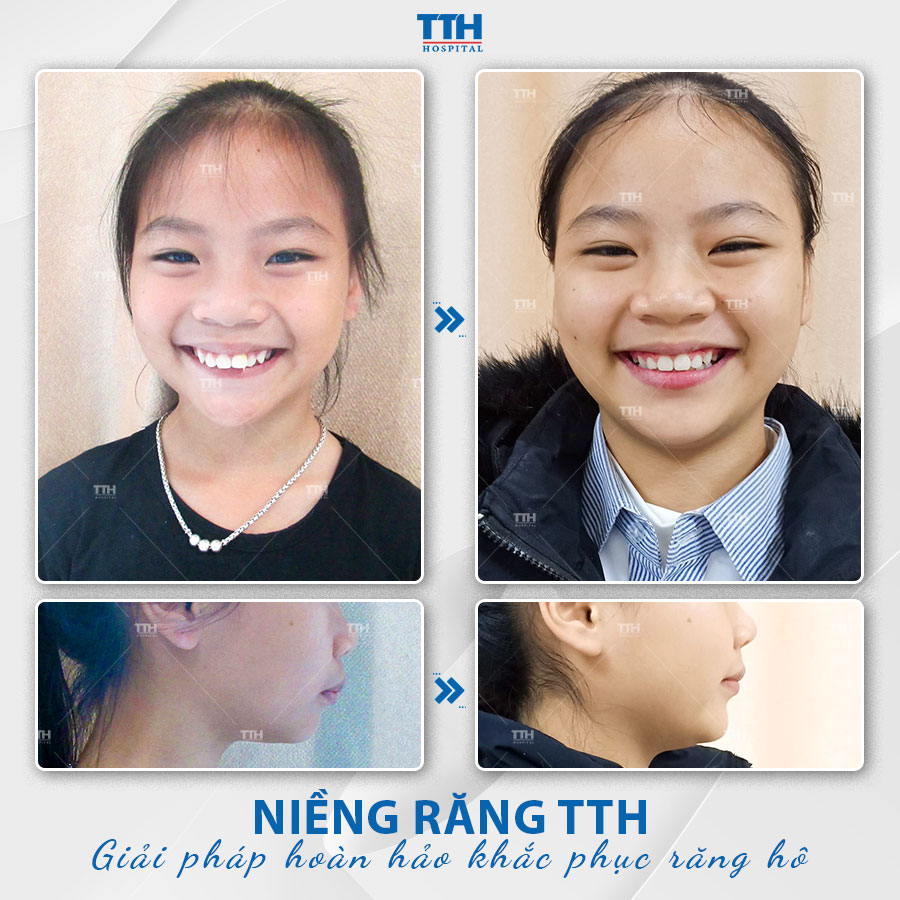 Bệnh viện Thái Thượng Hoàng - Địa chỉ niềng răng hô uy tín