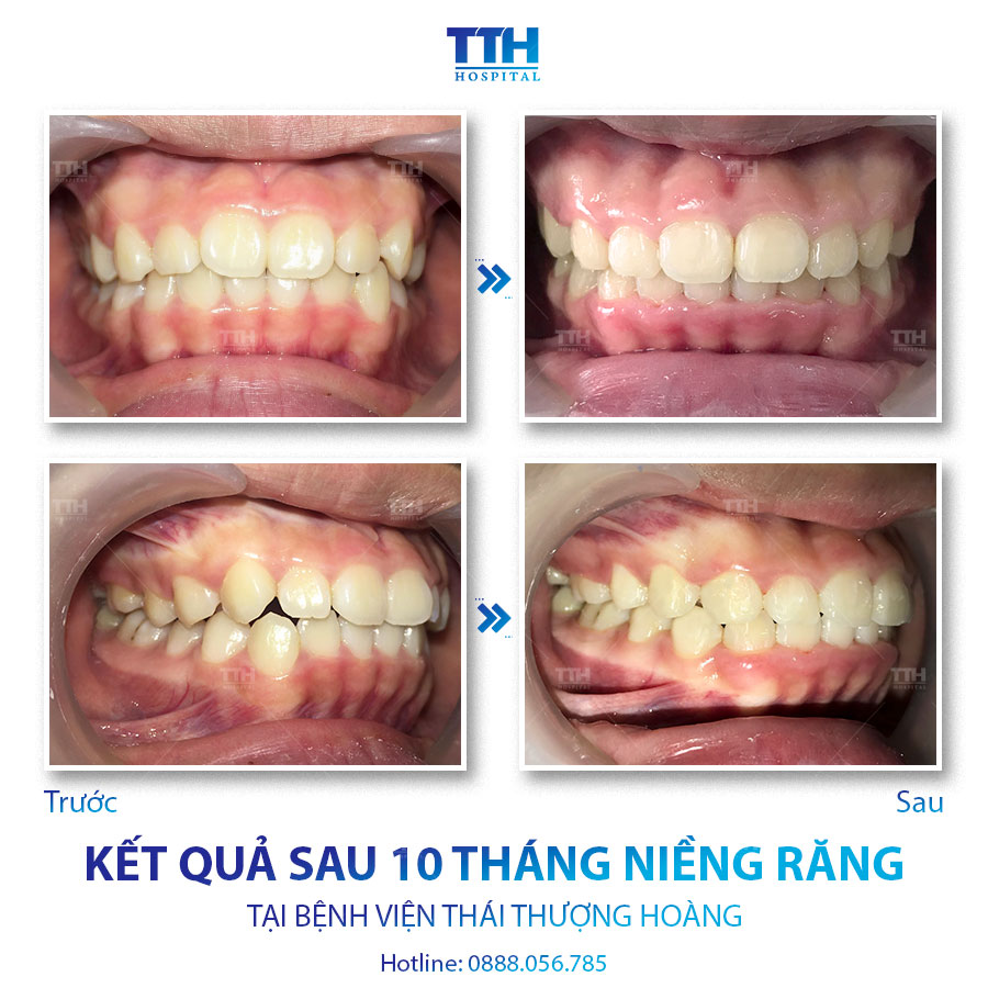 Loạt hình ảnh khách hàng sau khi niềng răng tại Bệnh viện Thái Thượng Hoàng 6
