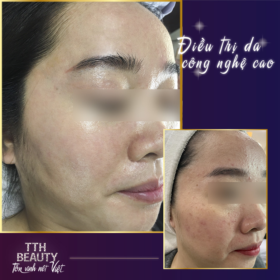 Điều trị mụn công nghệ ánh sáng IPL tại Nghệ An sẽ giúp xóa tan nỗi ám ảnh về mụn của chị em phụ nữ