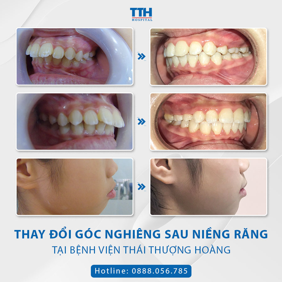 Loạt hình ảnh khách hàng sau khi niềng răng tại Bệnh viện Thái Thượng Hoàng
