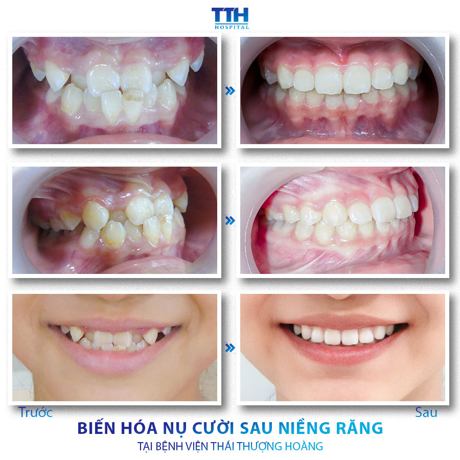 Kết quả Khách hàng sau niềng răng tại Bệnh viện Thái Thượng Hoàng