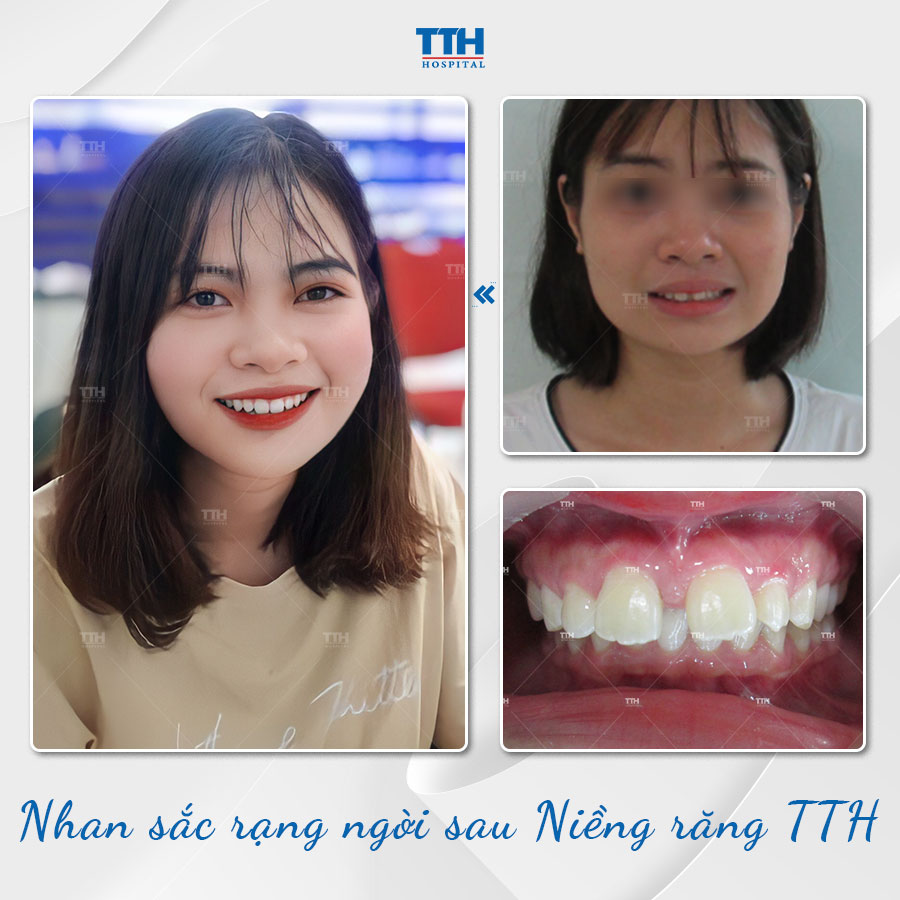 Loạt hình ảnh khách hàng sau khi niềng răng tại Bệnh viện Thái Thượng Hoàng 2