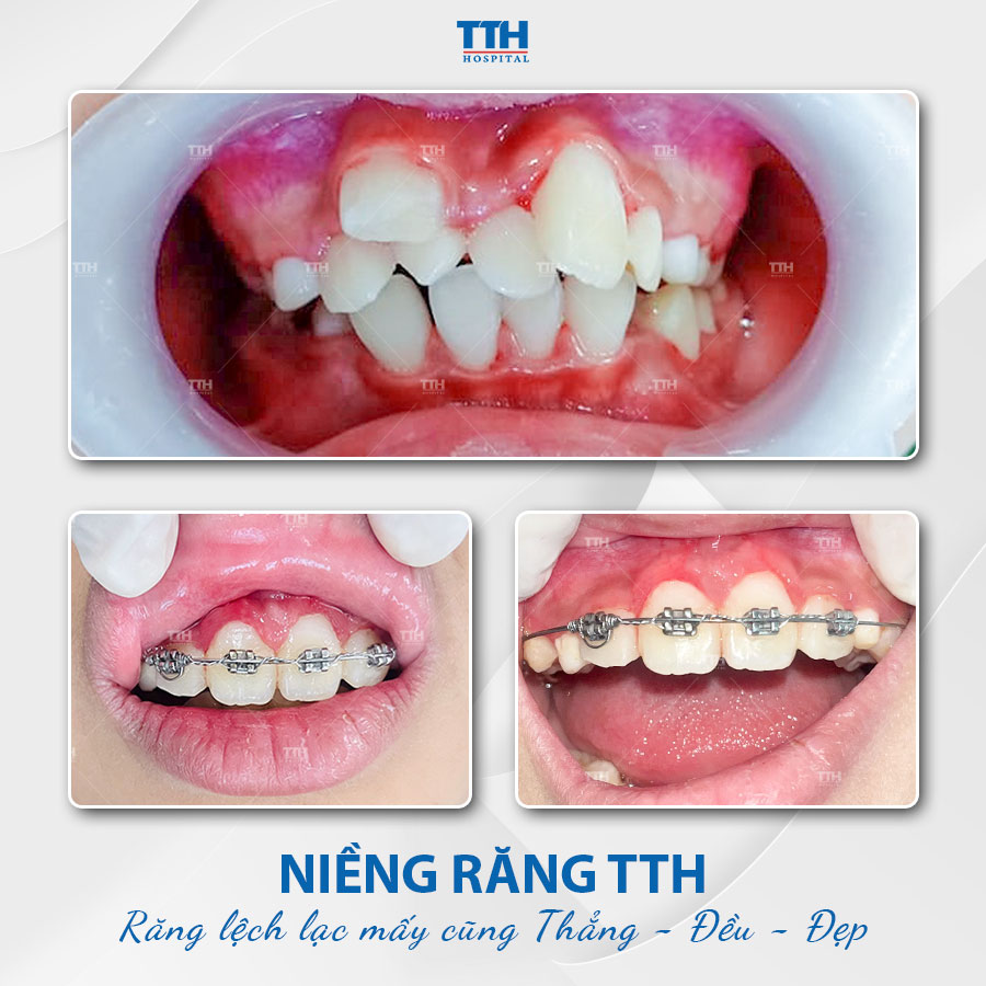 Một số hình ảnh khách hàng niềng răng tại bệnh viện Thái Thượng Hoàng