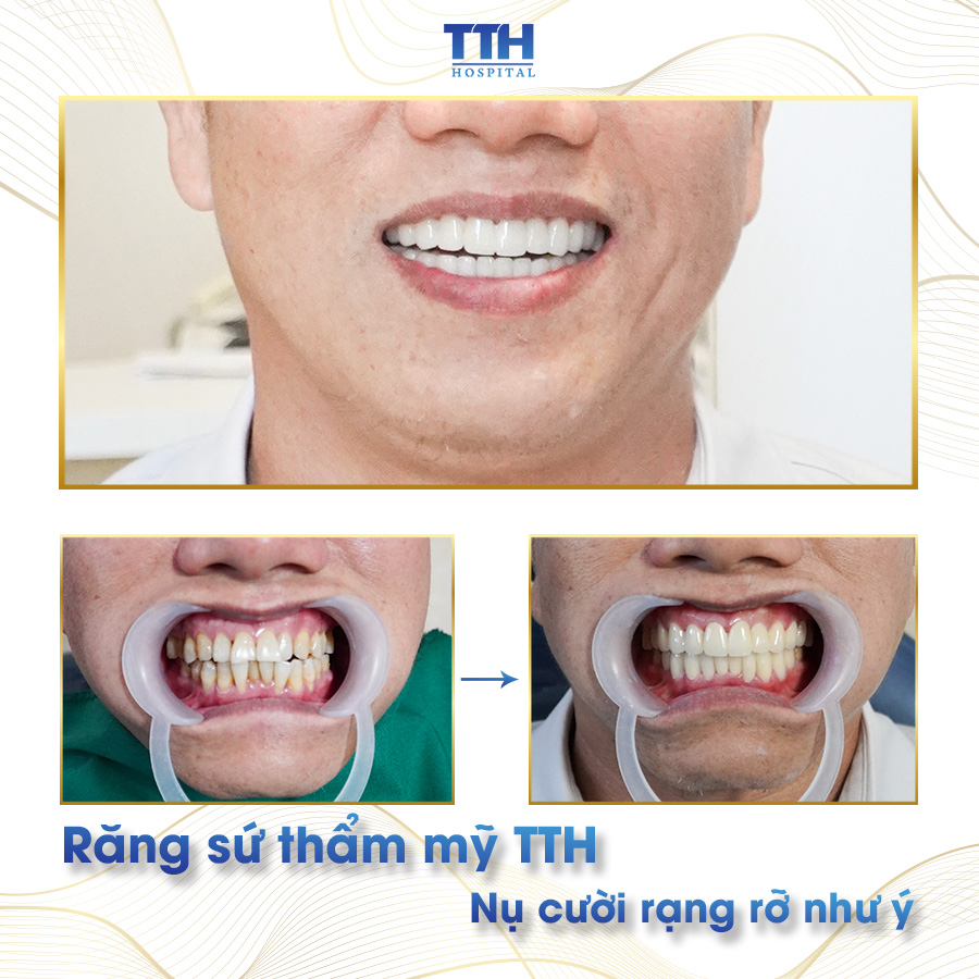 MỘT SỐ HÌNH ẢNH KHÁCH HÀNG SAU KHI THẨM MỸ RĂNG SỨ TẠI BỆNH VIỆN THÁI THƯỢNG HOÀNG 1