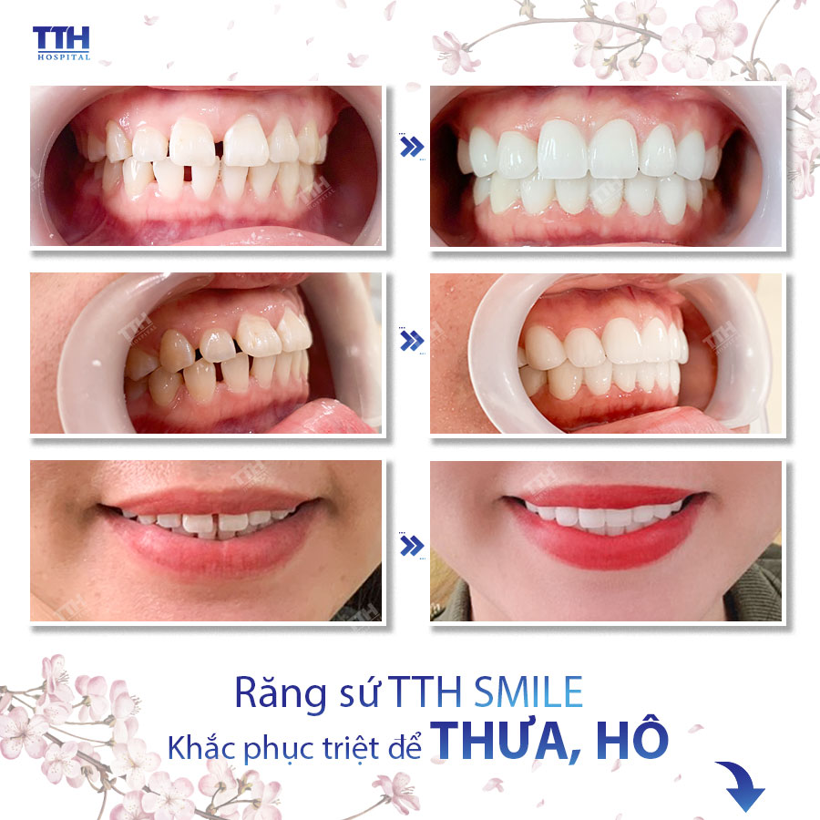 MỘT SỐ HÌNH ẢNH KHÁCH HÀNG SAU KHI THẨM MỸ RĂNG SỨ TẠI BỆNH VIỆN THÁI THƯỢNG HOÀNG