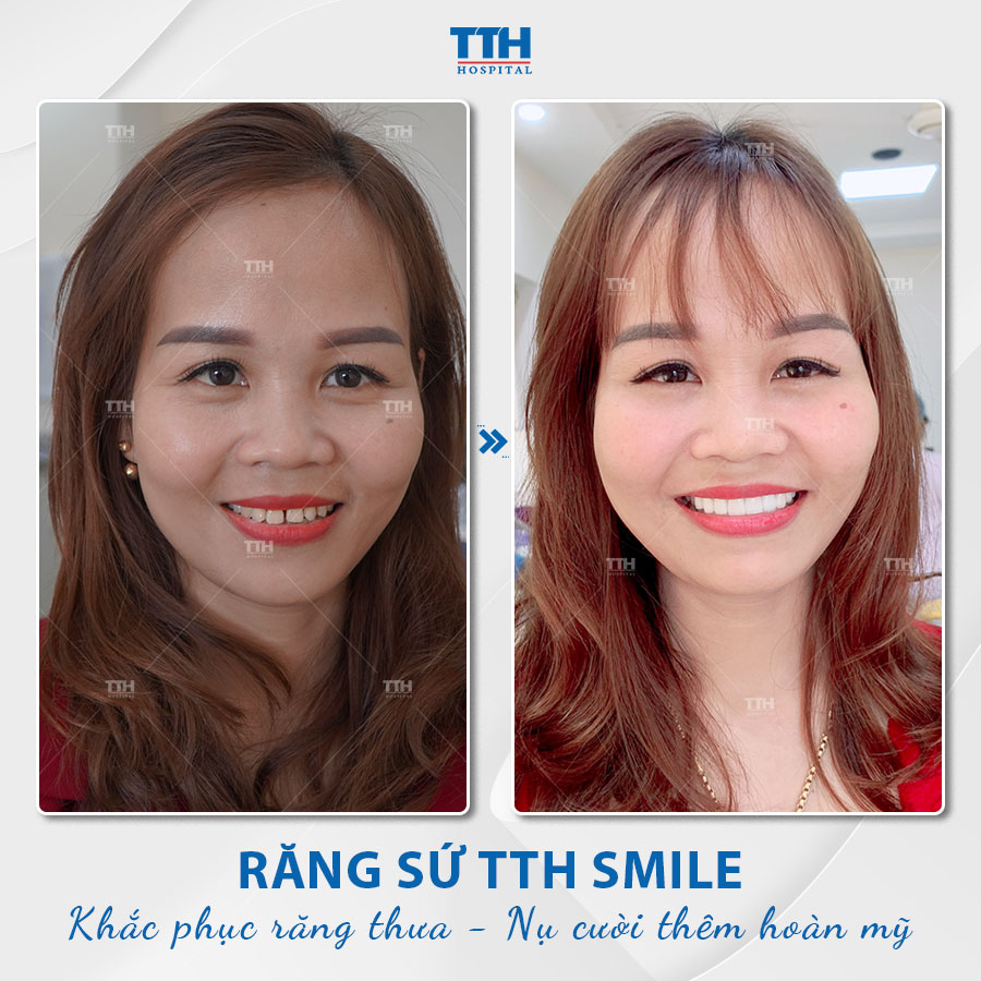 Ưu điểm bọc răng sứ thẩm mỹ 3