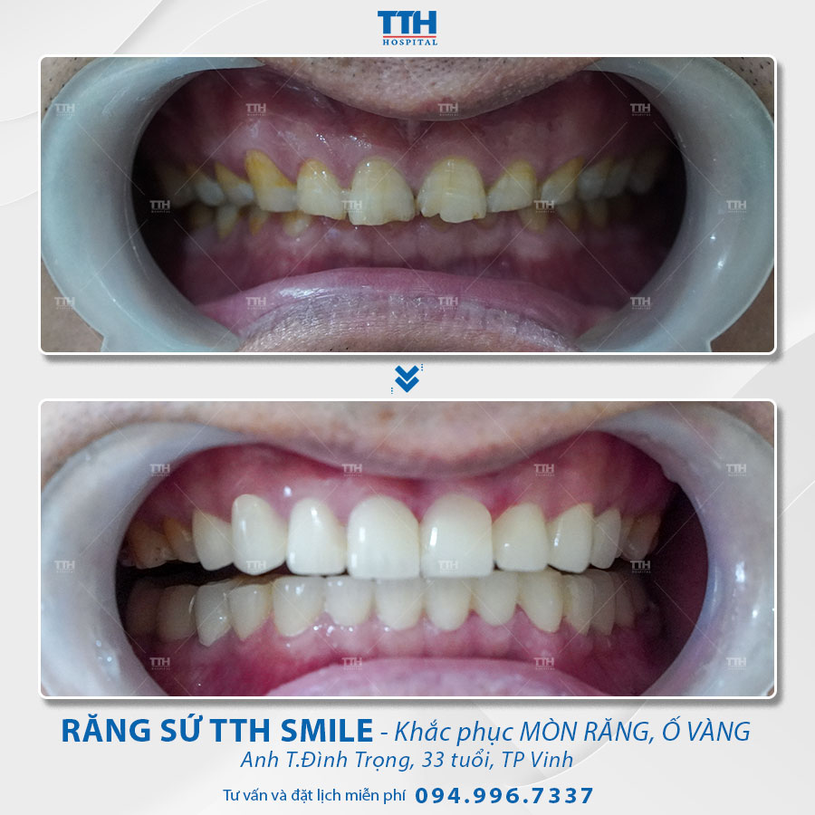 Khắc phục mòn răng hiệu quả với bọc răng sứ
