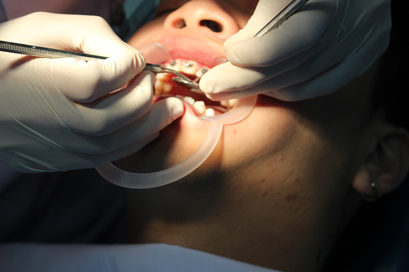 Ưu điểm của phương pháp niềng răng