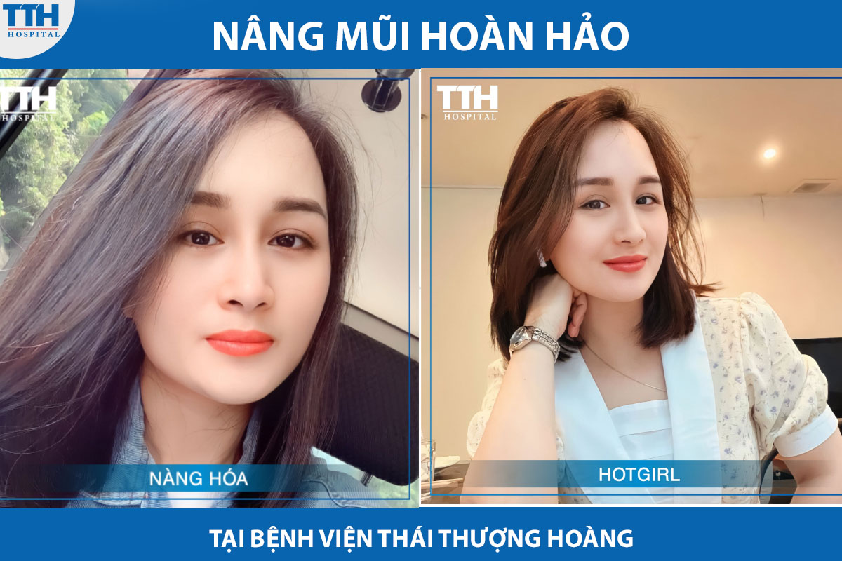 Khách hàng luôn hài lòng khi thực hiện nâng mũi tại bệnh viện Thái Thượng Hoàng