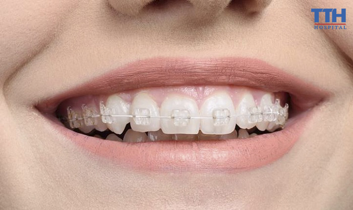 Niềng răng mắc cài sứ sử dụng mắc cài làm từ hợp kim sứ cùng với một số chất liệu vô cơ khác, đảm bảo sự an toàn cho cơ thể và không gây kích ứng