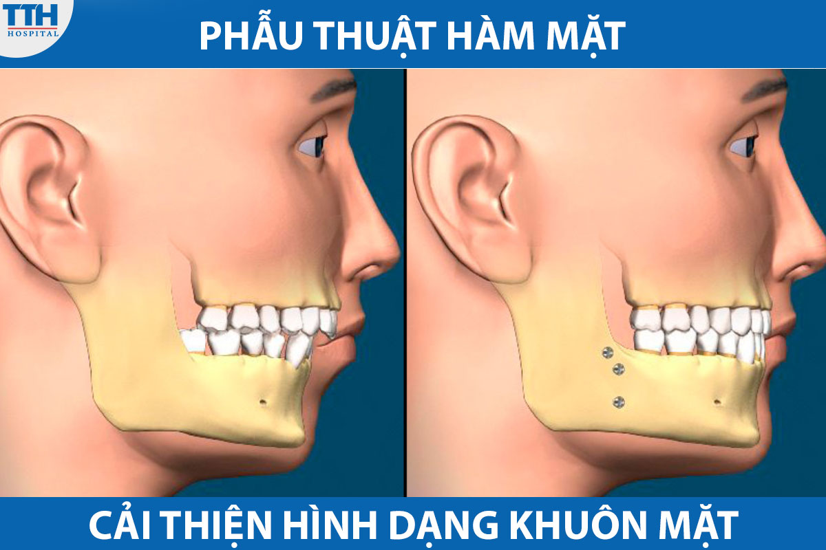 Phẫu thuật hàm mặt