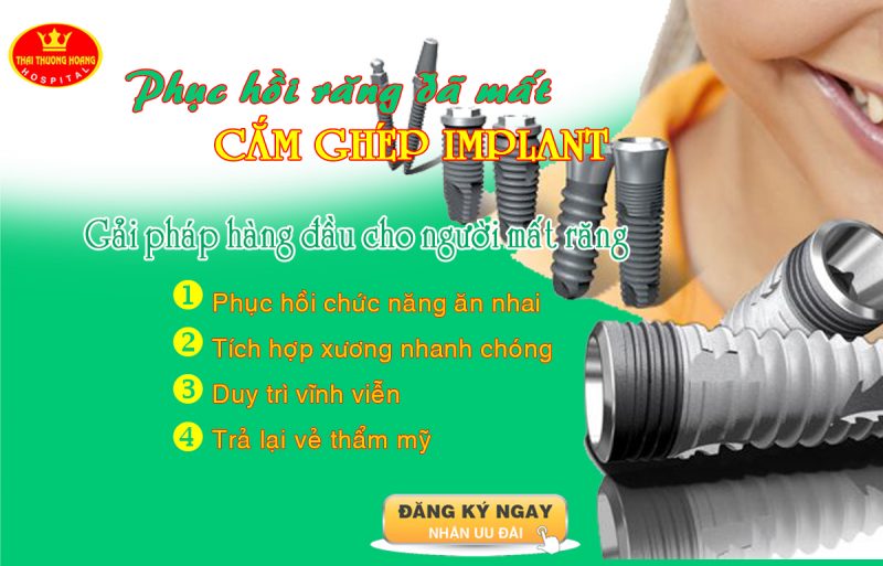 Trồng răng Implant là gì?