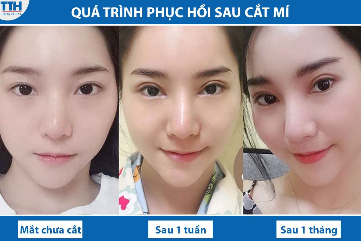 Quá trình phục hồi sau khi cắt mí
