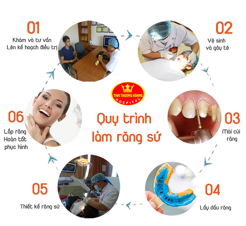 Quy trình bọc răng sứ thẩm mỹ tại Bệnh viện Thái Thượng Hoàng