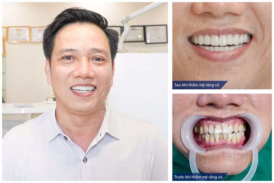 QUY TRÌNH BỌC RĂNG SỨ TẠI BỆNH VIỆN THÁI THƯỢNG HOÀNG 1