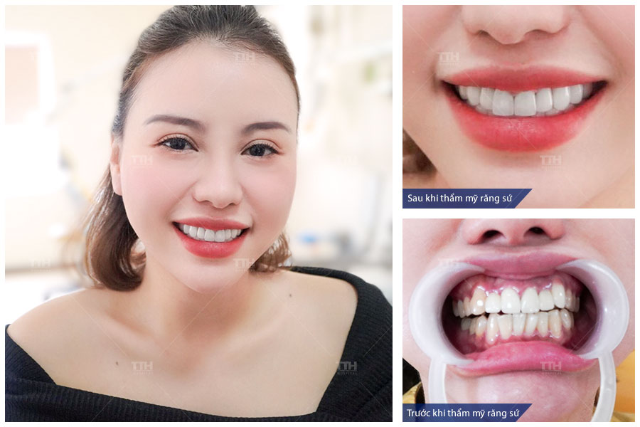 QUY TRÌNH BỌC RĂNG SỨ TẠI BỆNH VIỆN THÁI THƯỢNG HOÀNG 2