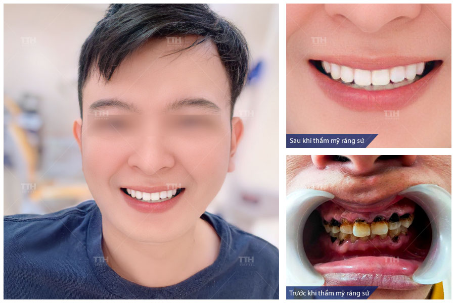 MỘT SỐ HÌNH ẢNH KHÁCH HÀNG SAU KHI THẨM MỸ RĂNG SỨ TẠI BỆNH VIỆN THÁI THƯỢNG HOÀNG 3