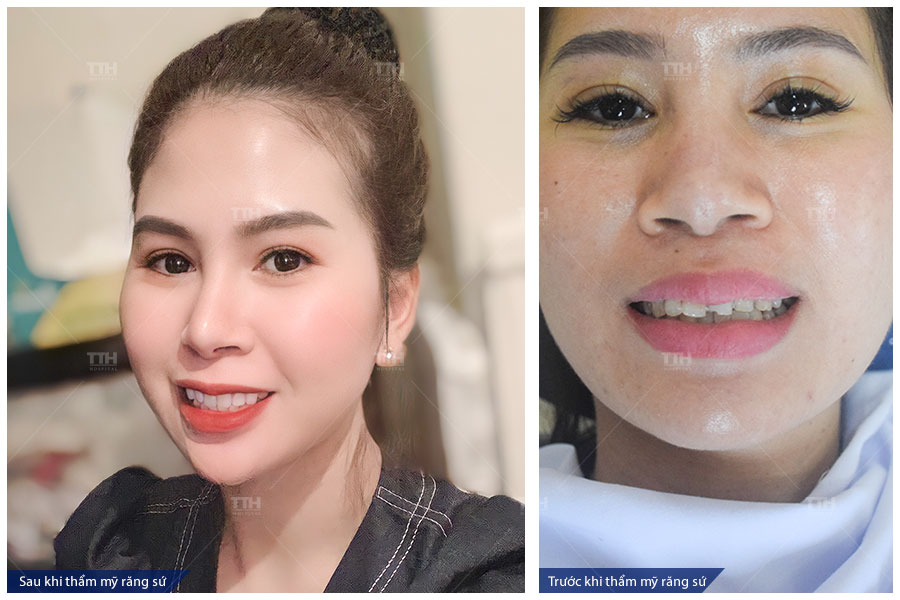 QUY TRÌNH BỌC RĂNG SỨ TẠI BỆNH VIỆN THÁI THƯỢNG HOÀNG