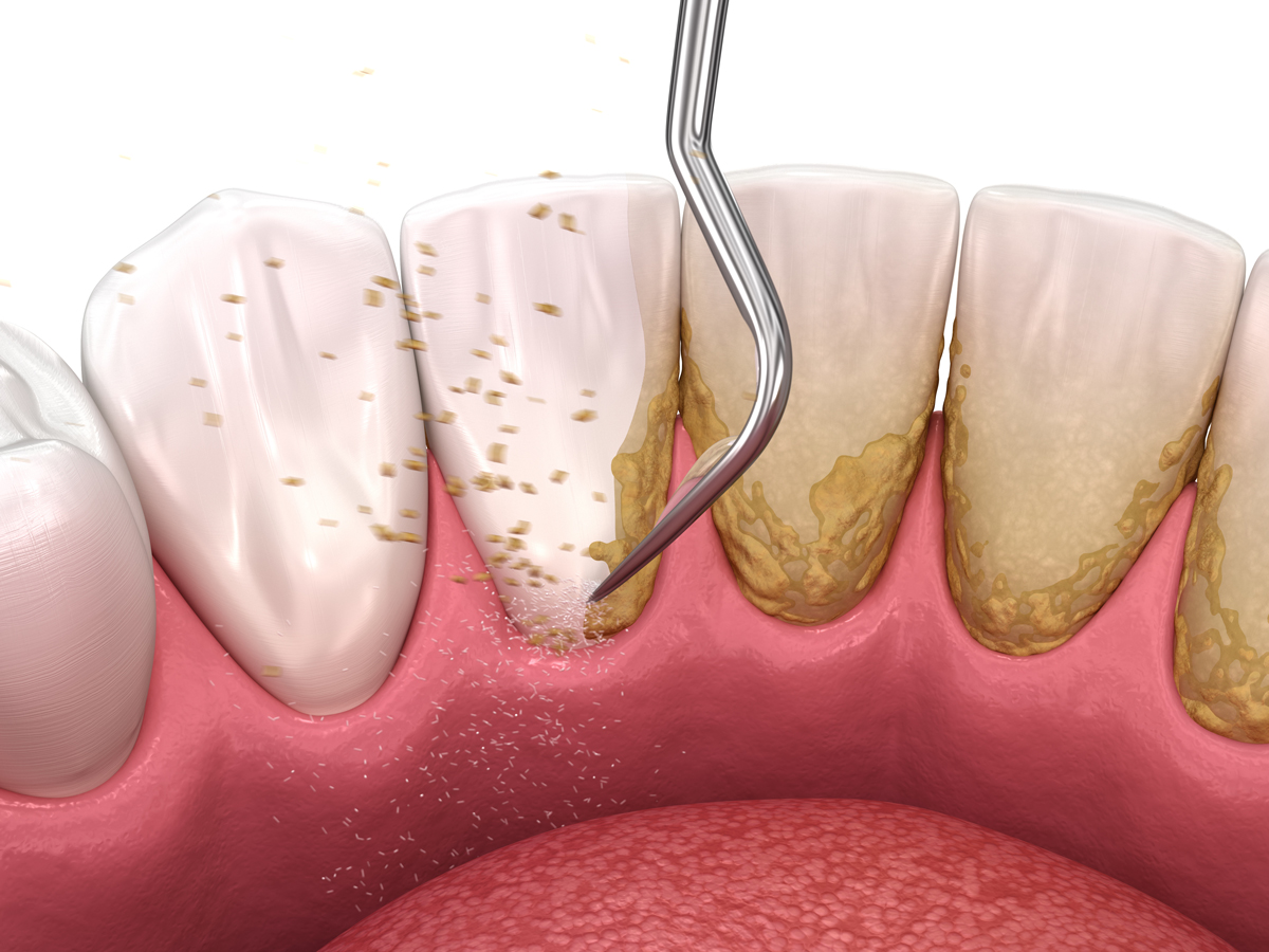 Bọc răng sứ có lấy cao răng được không?