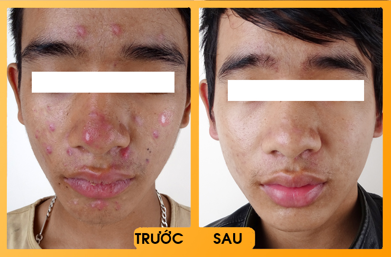 Hình ảnh khách hàng sau khi điều trị mụn tại bệnh viện thái thượng hoàng 1