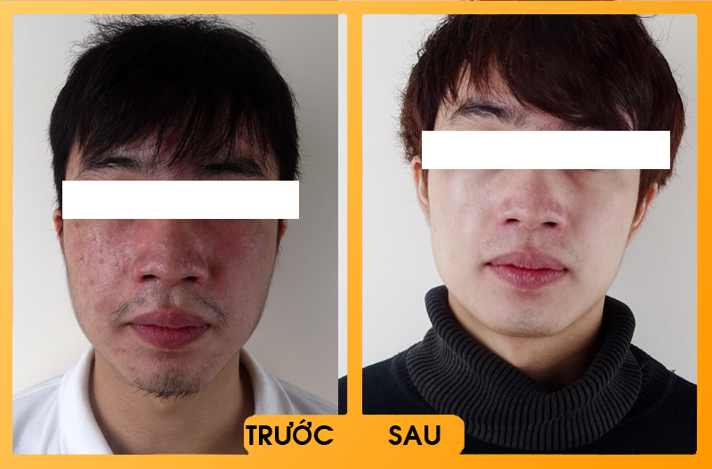 Hình ảnh khách hàng sau khi điều trị mụn tại bệnh viện thái thượng hoàng 2