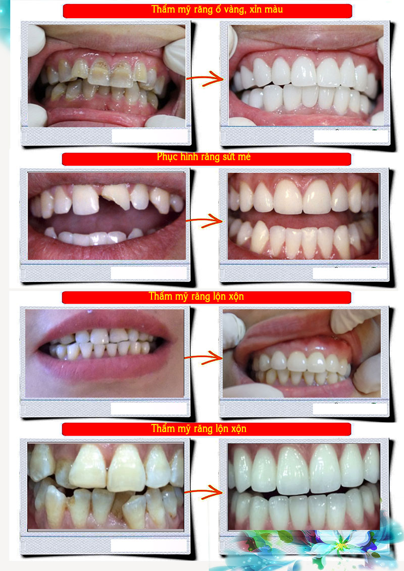 Những câu hỏi thường gặp về bọc răng sứ thẩm mỹ