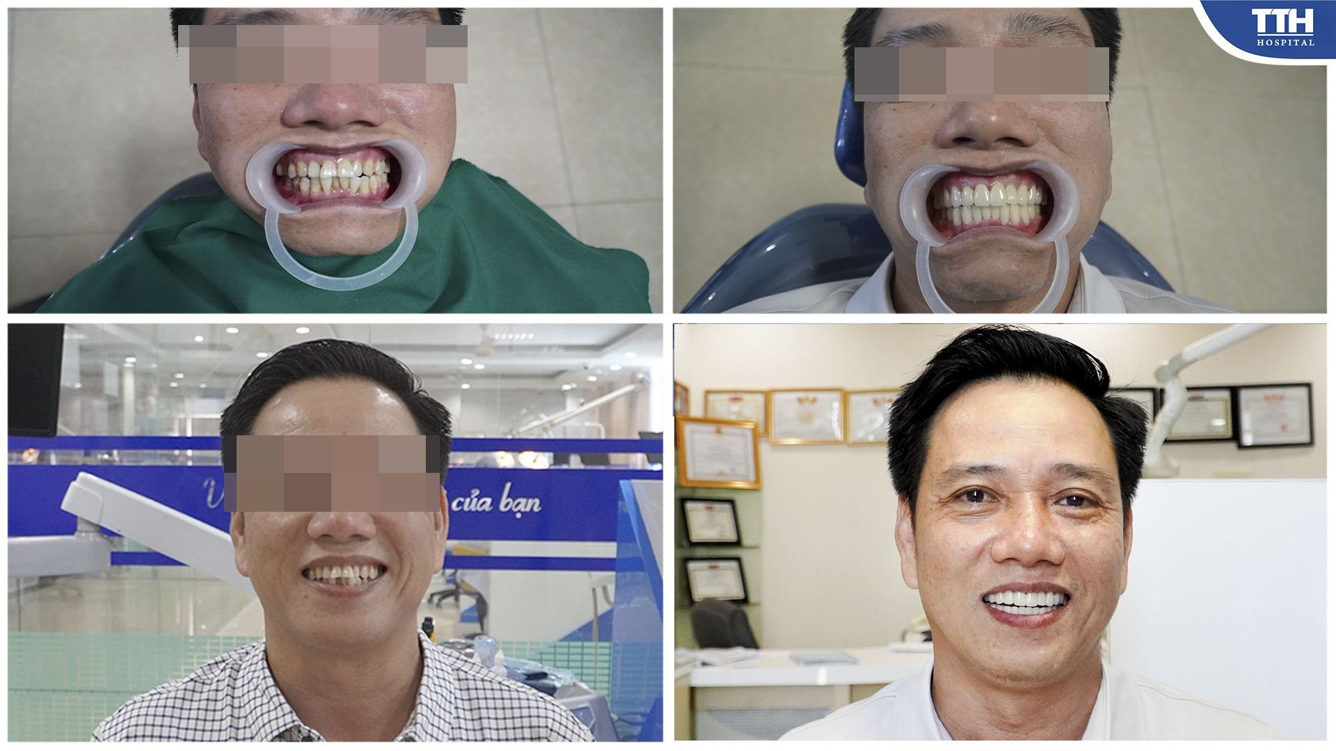 Nụ cười của khách hàng đã được cải thiện nhờ ứng dụng công nghệ thiết kế nụ cười TTH Smile