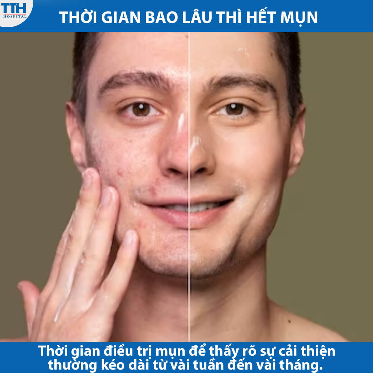 Thời gian bao lâu thì hết mụn