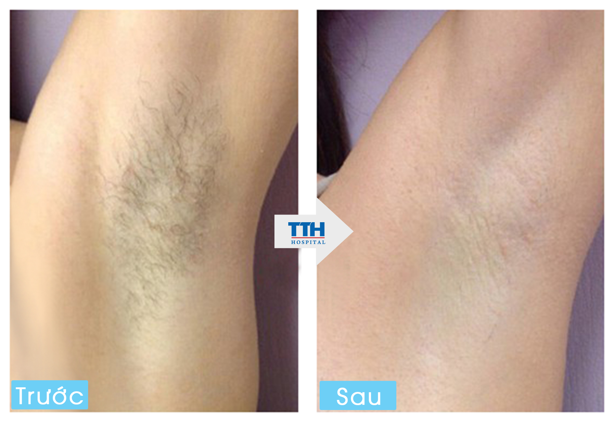 Triệt lông tại thái thượng hoàng