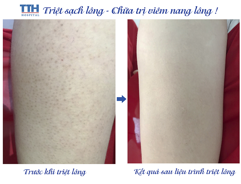 tRIỆT SẠCH lông