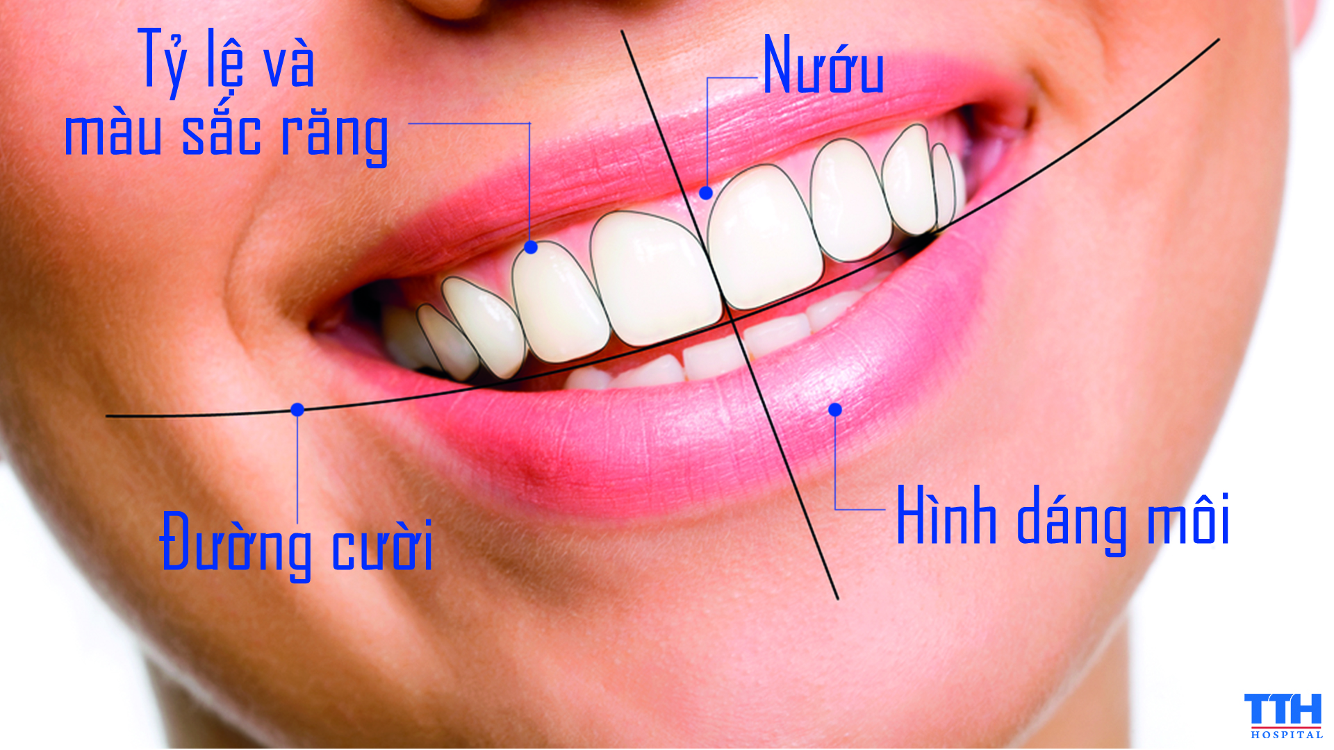 Công nghệ TTH Smile dựa trên các yếu tố về môi, đường cười, răng và nướu để phân tích và thiết kế nụ cười