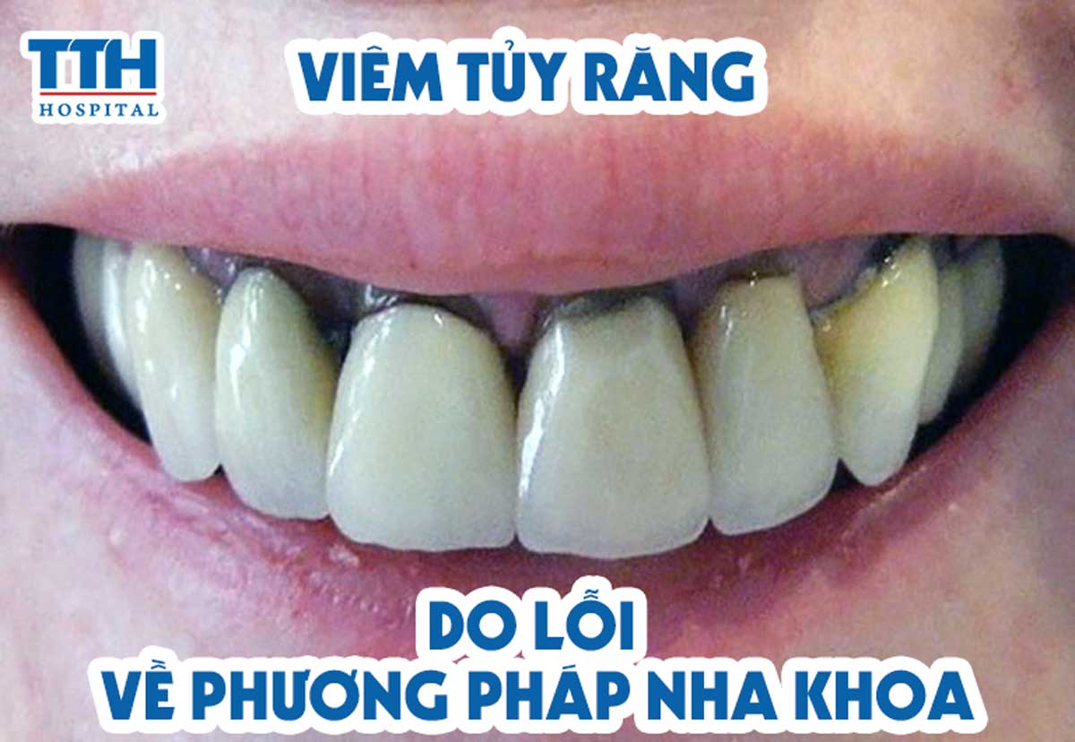 Viêm tủy răng do lỗi về phương pháp nha khoa