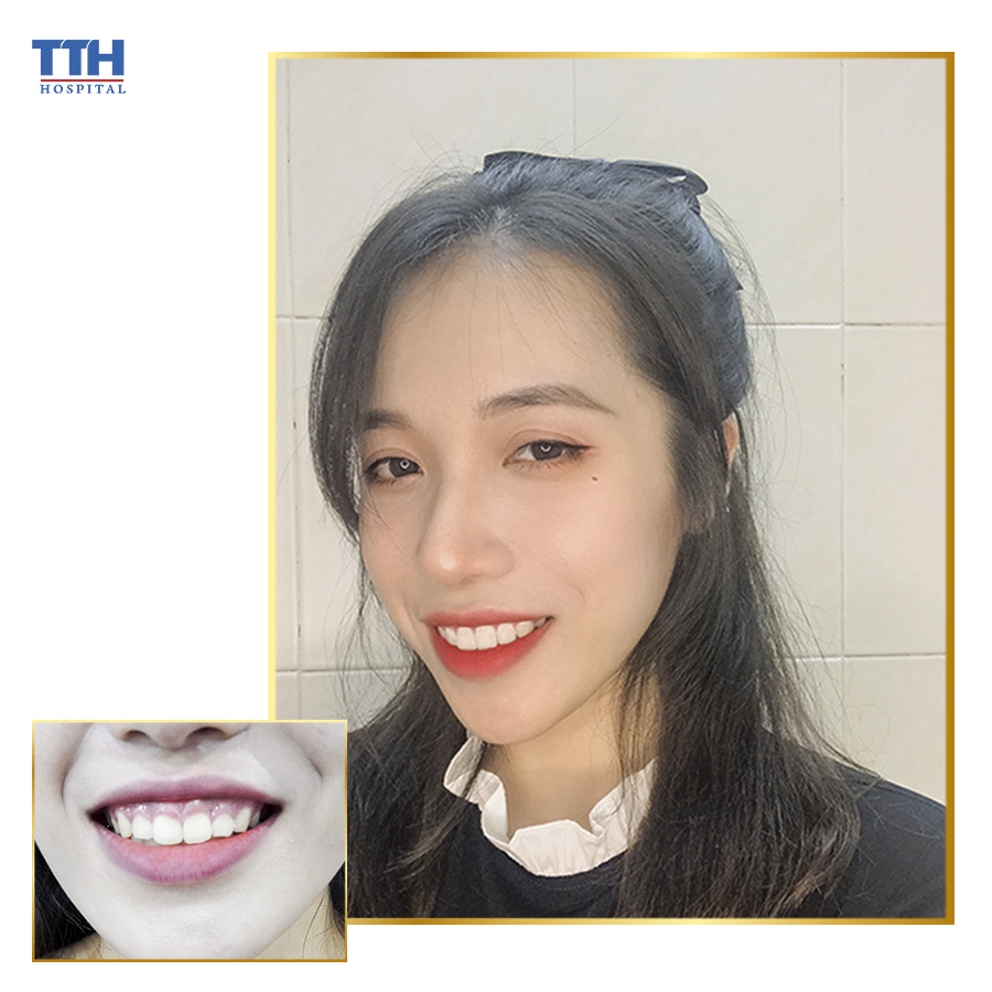 Điều trị cười hở lợi với phẫu thuật xương hàm