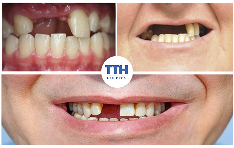 Các trường hợp mất 1 răng, nhiều răng hay mất răng toàn hàm nên thực hiện cắm ghép implant