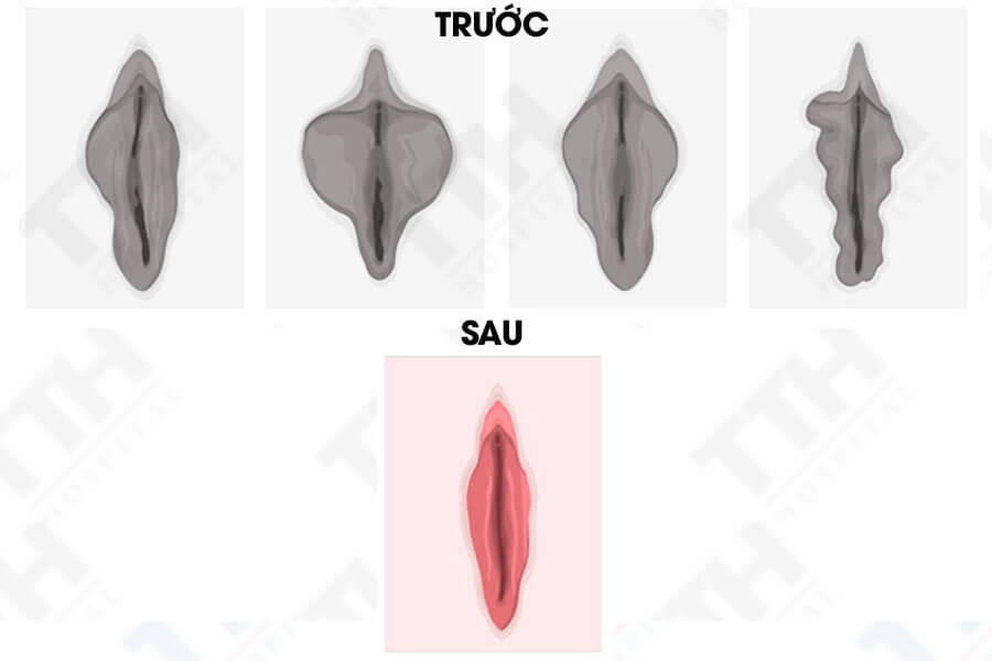Ai nên cân nhắc tạo hình môi lớn?
