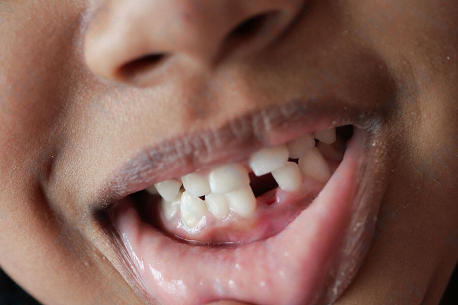 Ai nên cân nhắc trồng răng implant?