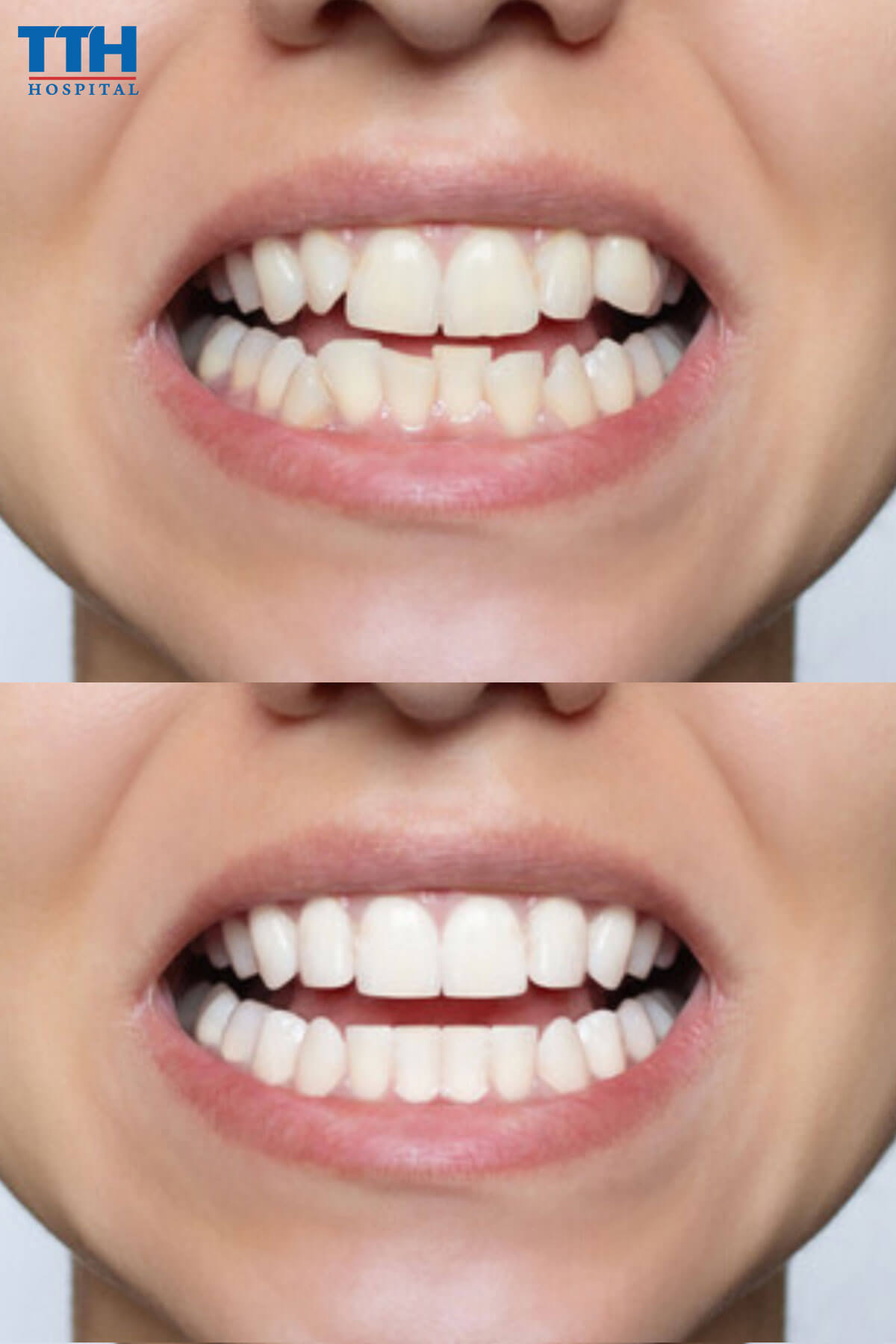 Ai nên sử dụng răng sứ Diamond Veneer?