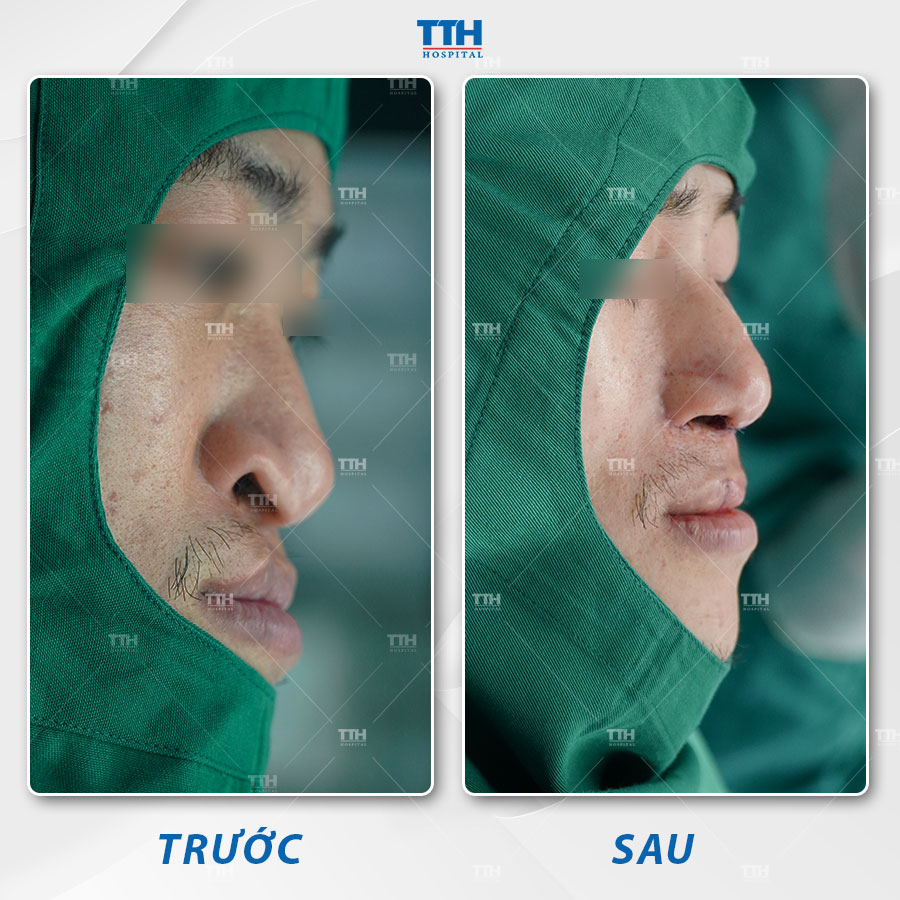 Lưu ý chăm sóc sau sửa mũi lệch
