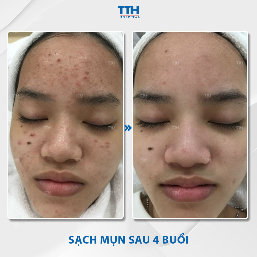 Hình ảnh khách hàng sau điều trị mụn tại Bệnh viện Thái Thượng Hoàng 2