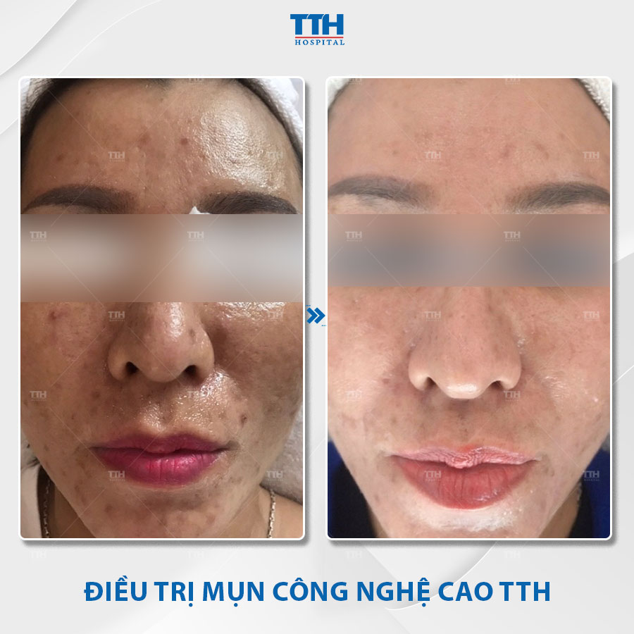 Hình ảnh khách hàng sau điều trị mụn tại Bệnh viện Thái Thượng Hoàng 3