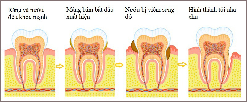 Bệnh viêm lợi là một trong những bệnh lý rất phổ biến