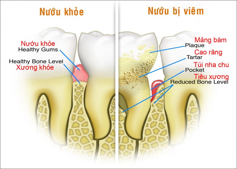 Miệng trẻ có mùi hôi, hơi thở của trẻ có mùi khó chịu