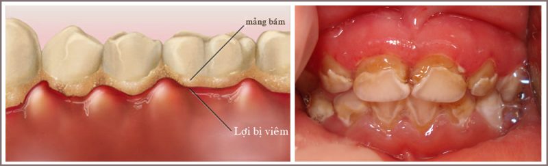 Viêm lợi cấp do tụ cầu: thường xuất hiện sau một đợt nhiễm khuẩn như trẻ bị viêm phổi, bị rối loạn tiêu hóa